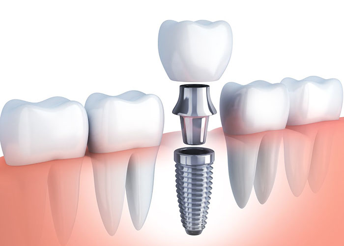 row human tooth and Dental implant. 3d illustration